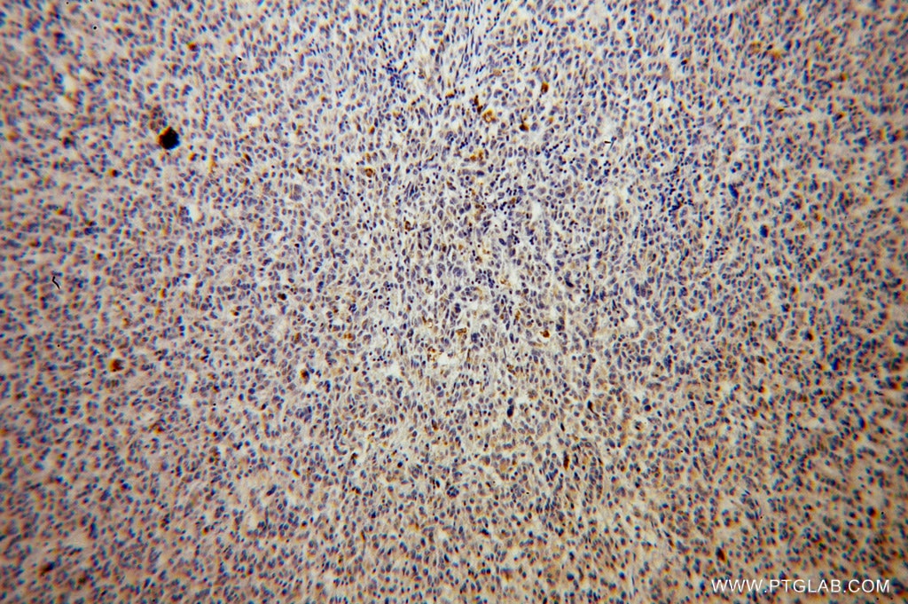Immunohistochemistry (IHC) staining of human malignant melanoma tissue using TAB2 Polyclonal antibody (14410-1-AP)
