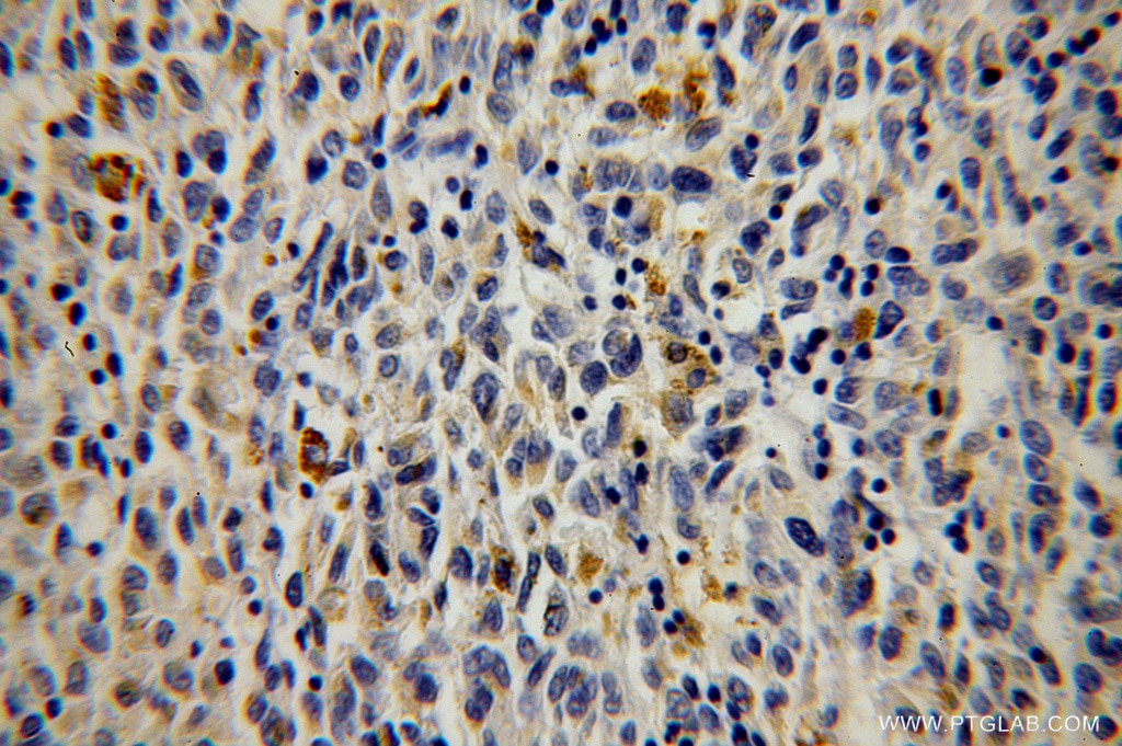 Immunohistochemistry (IHC) staining of human malignant melanoma tissue using TAB2 Polyclonal antibody (14410-1-AP)