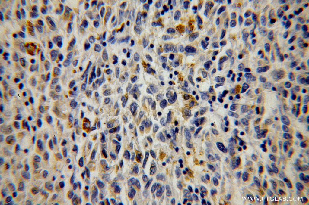 IHC staining of human malignant melanoma using 14410-1-AP