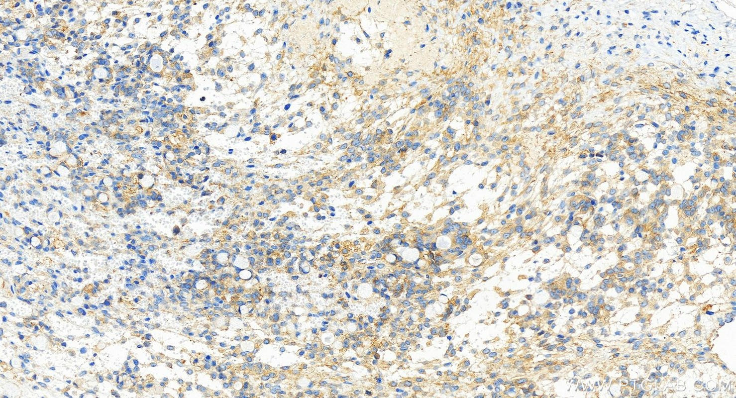 Immunohistochemical analysis of paraffin-embedded human ovary cancer tissue slide using 82948-1-RR (TAB2 antibody) at dilution of 1:500 (under 20x lens). Heat mediated antigen retrieval with Tris-EDTA buffer (pH 9.0). Immunohistochemistry (IHC) staining of human ovary cancer tissue using TAB2 Recombinant monoclonal antibody (82948-1-RR)