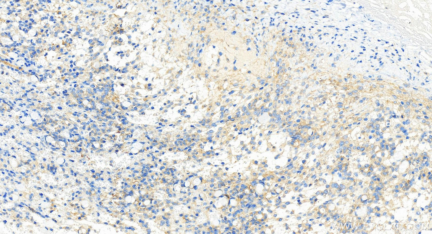 Immunohistochemistry (IHC) staining of human ovary cancer tissue using TAB2 Recombinant monoclonal antibody (82948-5-RR)