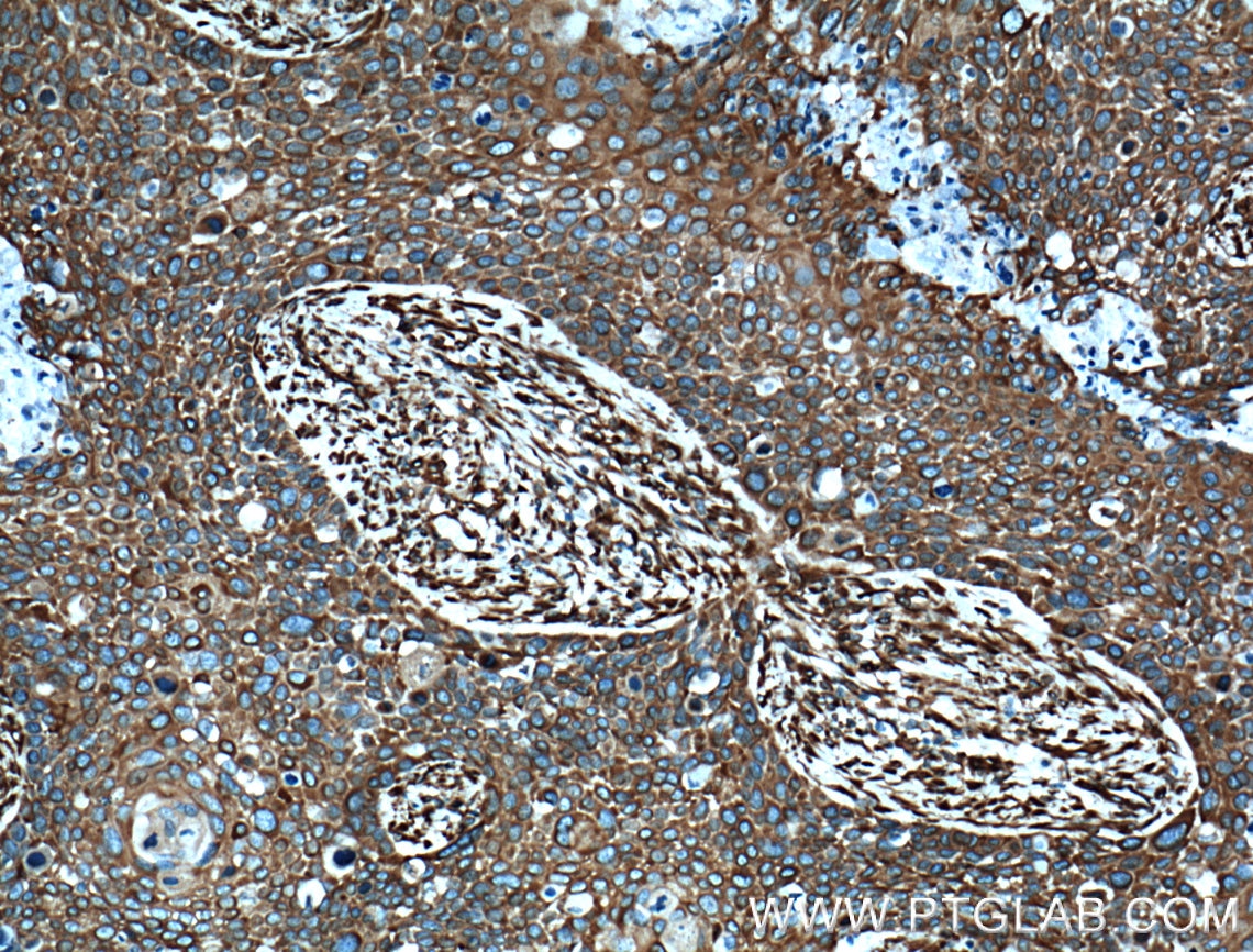 Immunohistochemistry (IHC) staining of human oesophagus cancer tissue using MAP4 Polyclonal antibody (11229-1-AP)