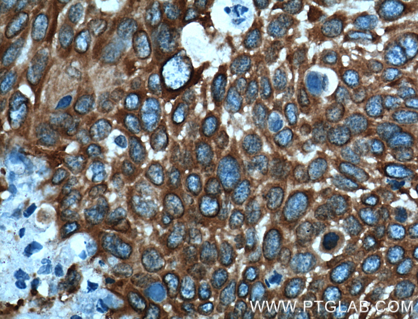 Immunohistochemistry (IHC) staining of human oesophagus cancer tissue using MAP4 Polyclonal antibody (11229-1-AP)