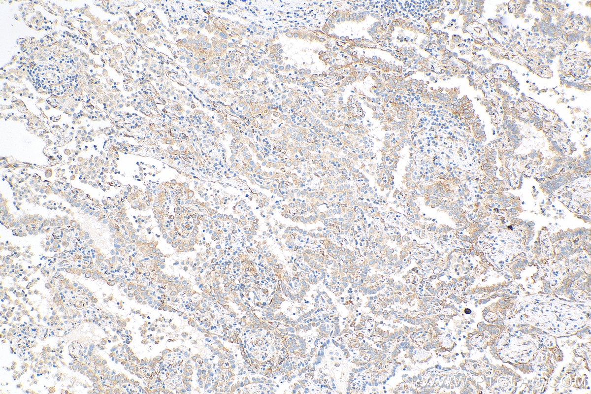 Immunohistochemistry (IHC) staining of human lung cancer tissue using MAP4 Monoclonal antibody (68271-1-Ig)