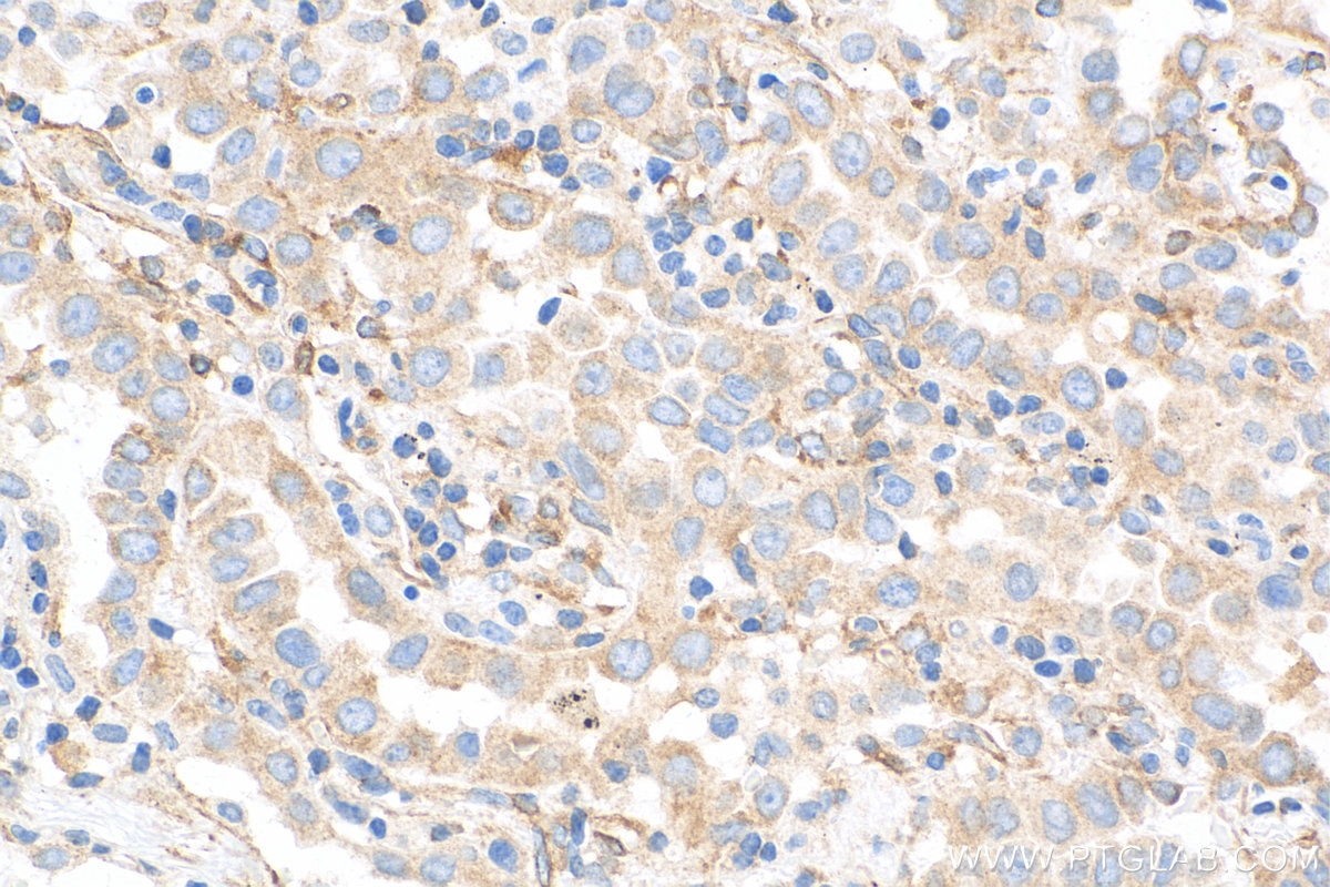 IHC staining of human lung cancer using 68271-1-Ig