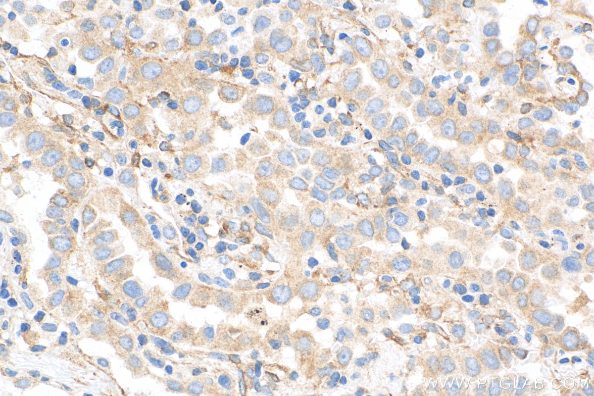 Immunohistochemistry (IHC) staining of human lung cancer tissue using MAP4 Monoclonal antibody (68271-1-Ig)