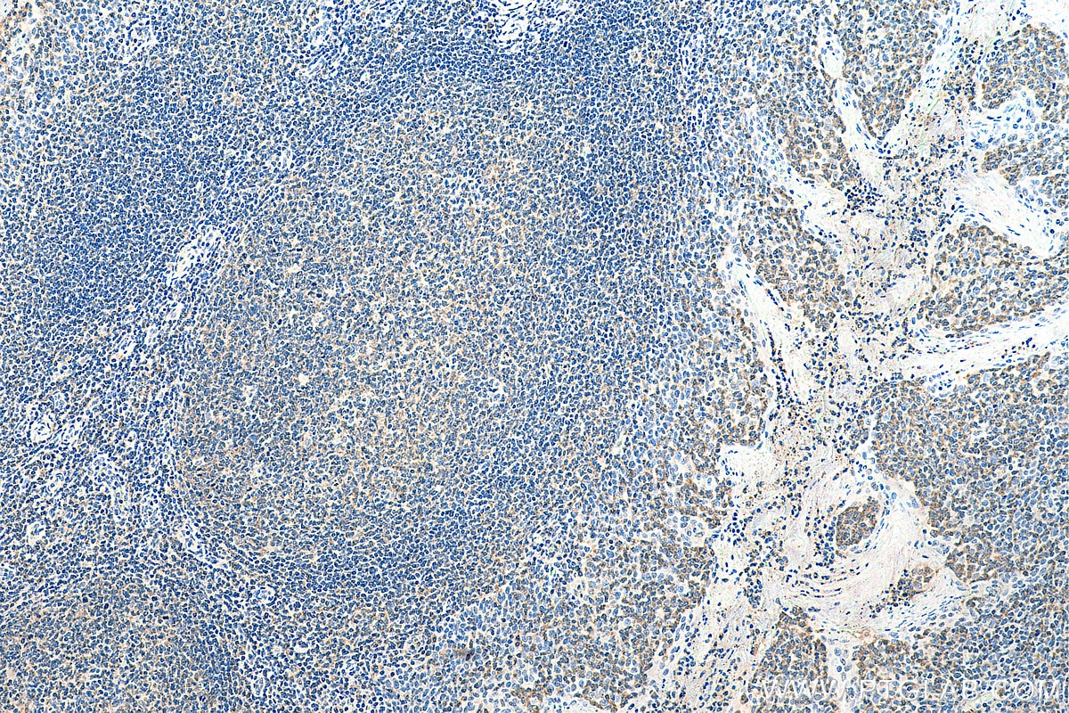 Immunohistochemistry (IHC) staining of human tonsillitis tissue using MAP4K1 Polyclonal antibody (23950-1-AP)