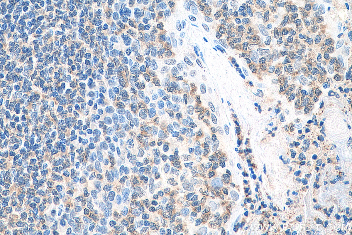 Immunohistochemistry (IHC) staining of human tonsillitis tissue using MAP4K1 Polyclonal antibody (23950-1-AP)