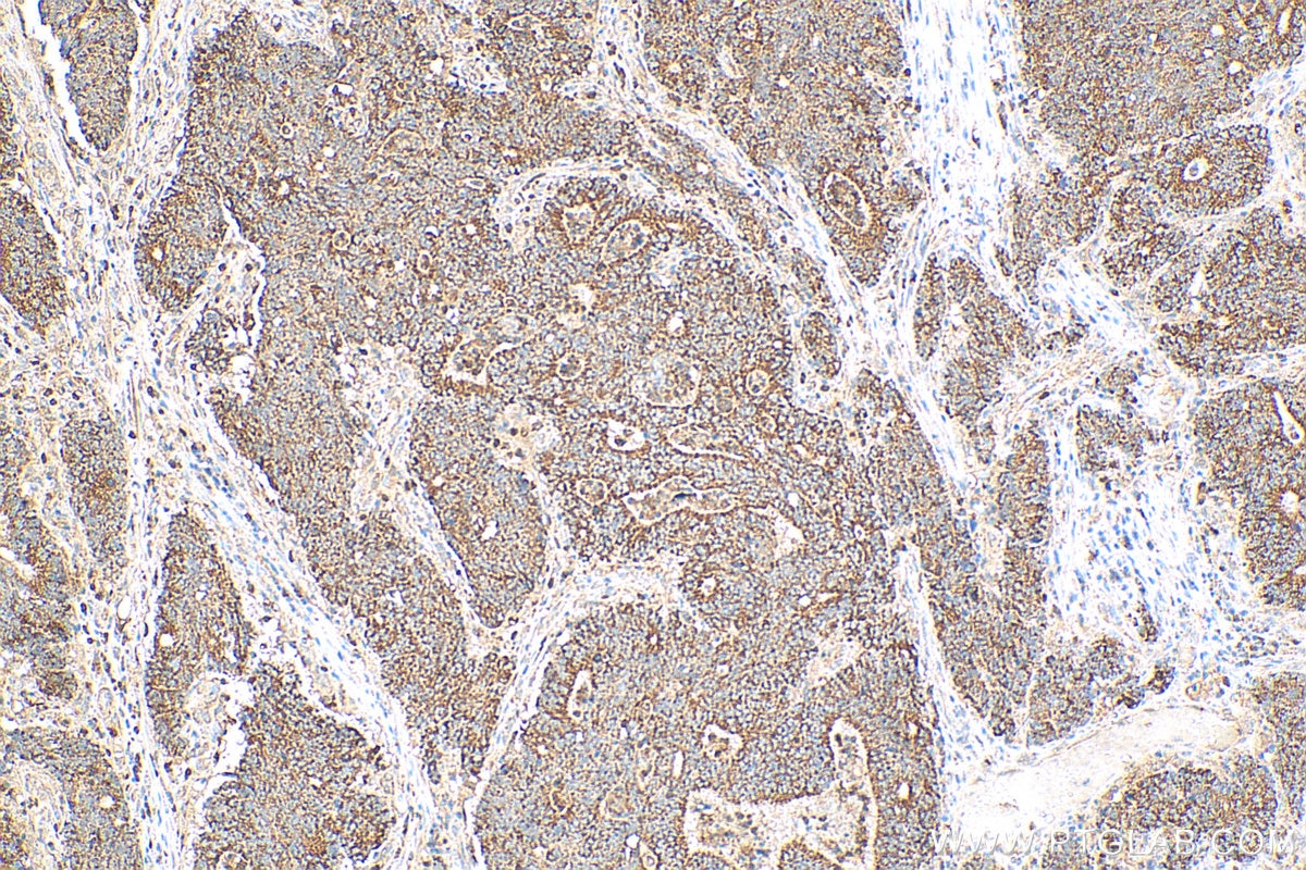 Immunohistochemistry (IHC) staining of human colon cancer tissue using MAP4K2 Polyclonal antibody (55244-1-AP)