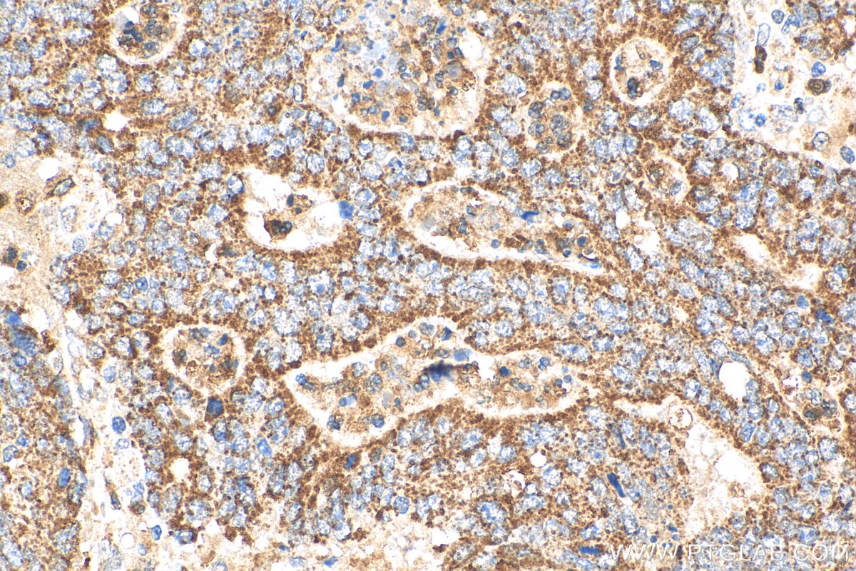 Immunohistochemistry (IHC) staining of human colon cancer tissue using MAP4K2 Polyclonal antibody (55244-1-AP)