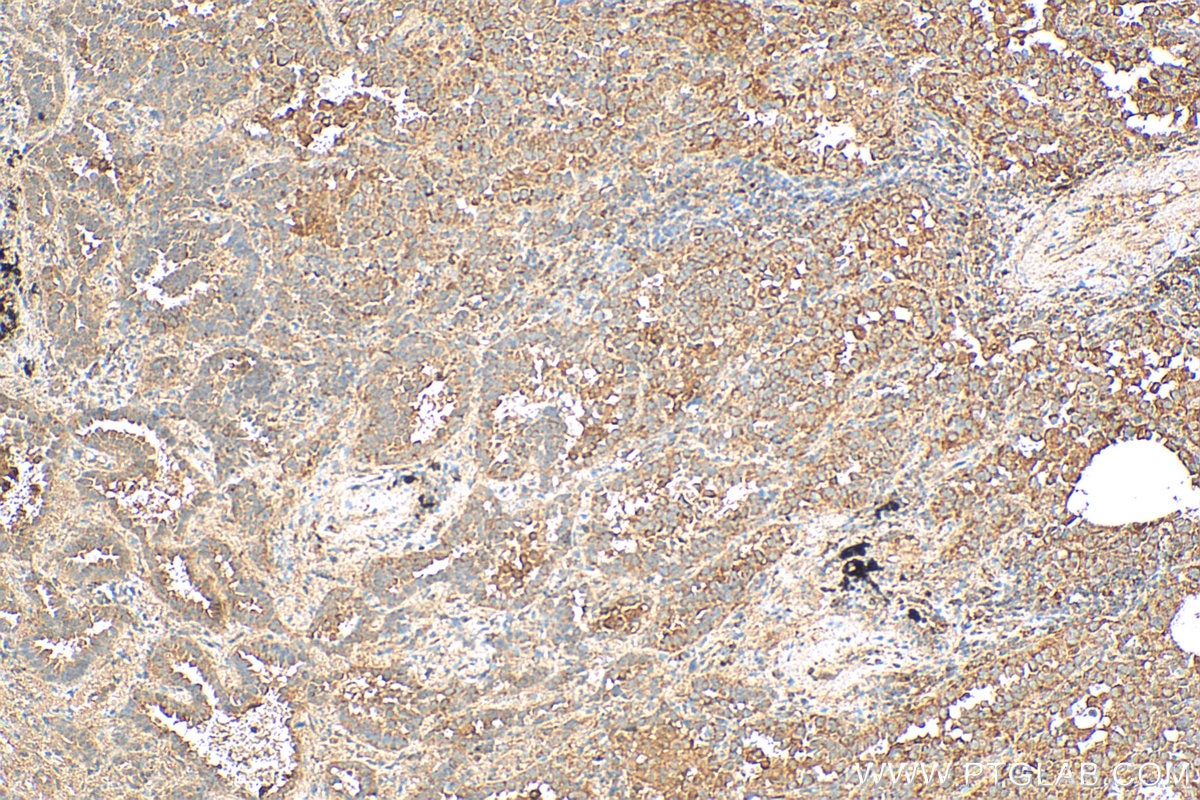 Immunohistochemistry (IHC) staining of human lung cancer tissue using MAP4K2 Polyclonal antibody (55244-1-AP)