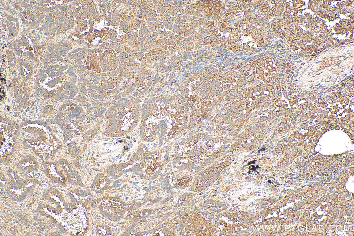 Immunohistochemistry (IHC) staining of human lung cancer tissue using MAP4K2 Polyclonal antibody (55244-1-AP)