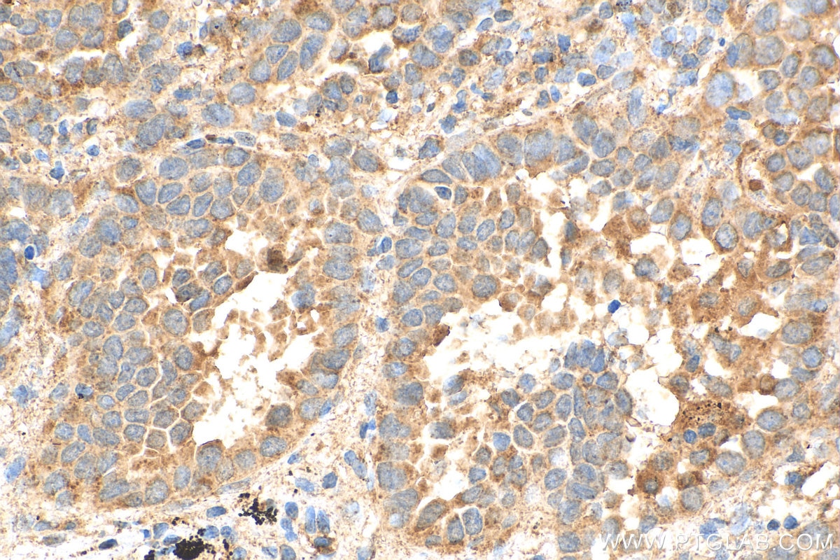 Immunohistochemistry (IHC) staining of human lung cancer tissue using MAP4K2 Polyclonal antibody (55244-1-AP)