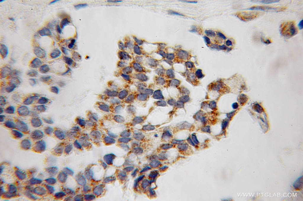 IHC staining of human ovary tumor using 12827-1-AP