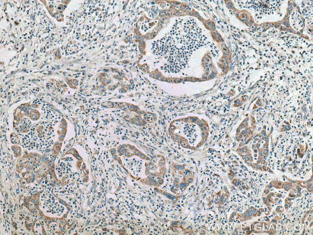 Immunohistochemistry (IHC) staining of human pancreas cancer tissue using SAPK4 Polyclonal antibody (10217-1-AP)