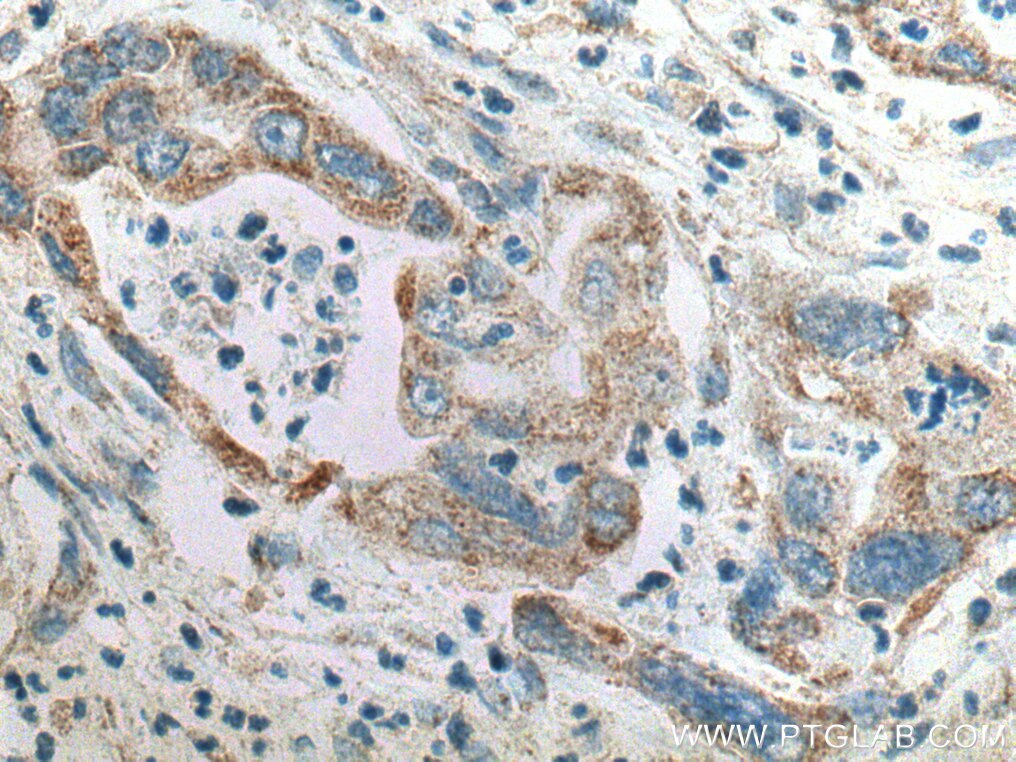 Immunohistochemistry (IHC) staining of human pancreas cancer tissue using SAPK4 Polyclonal antibody (10217-1-AP)