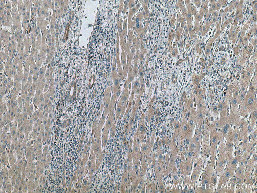 IHC staining of human liver cancer using 10217-1-AP