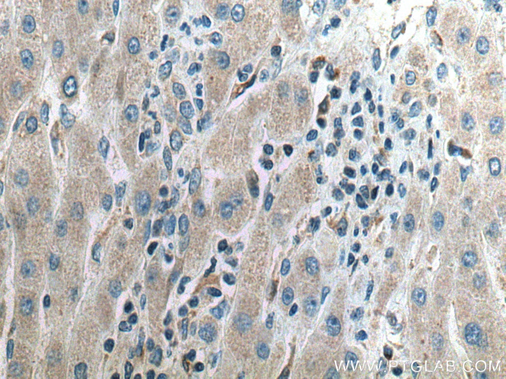 Immunohistochemistry (IHC) staining of human liver cancer tissue using SAPK4 Polyclonal antibody (10217-1-AP)