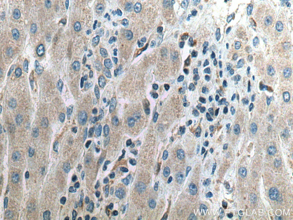 IHC staining of human liver cancer using 10217-1-AP