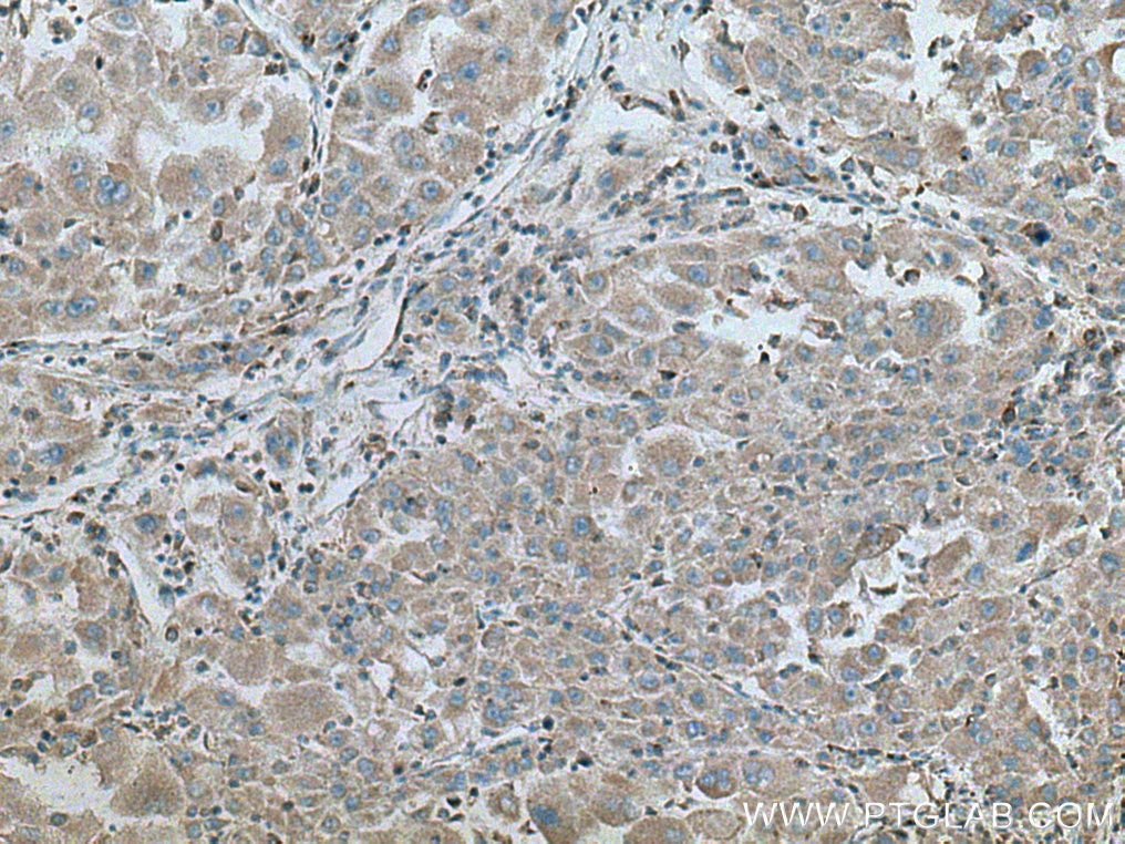Immunohistochemistry (IHC) staining of human liver cancer tissue using SAPK4 Polyclonal antibody (10217-1-AP)