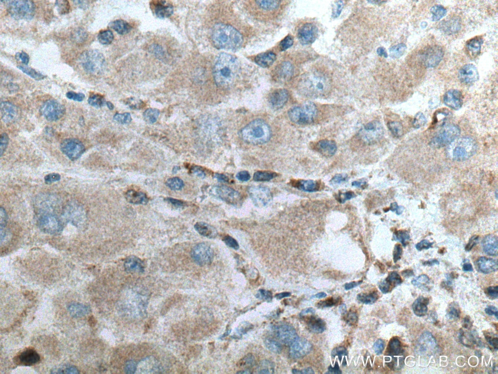 Immunohistochemistry (IHC) staining of human liver cancer tissue using SAPK4 Polyclonal antibody (10217-1-AP)