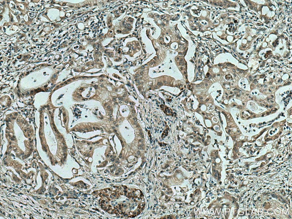 Immunohistochemistry (IHC) staining of human pancreas cancer tissue using MAPK13 Monoclonal antibody (60252-1-Ig)