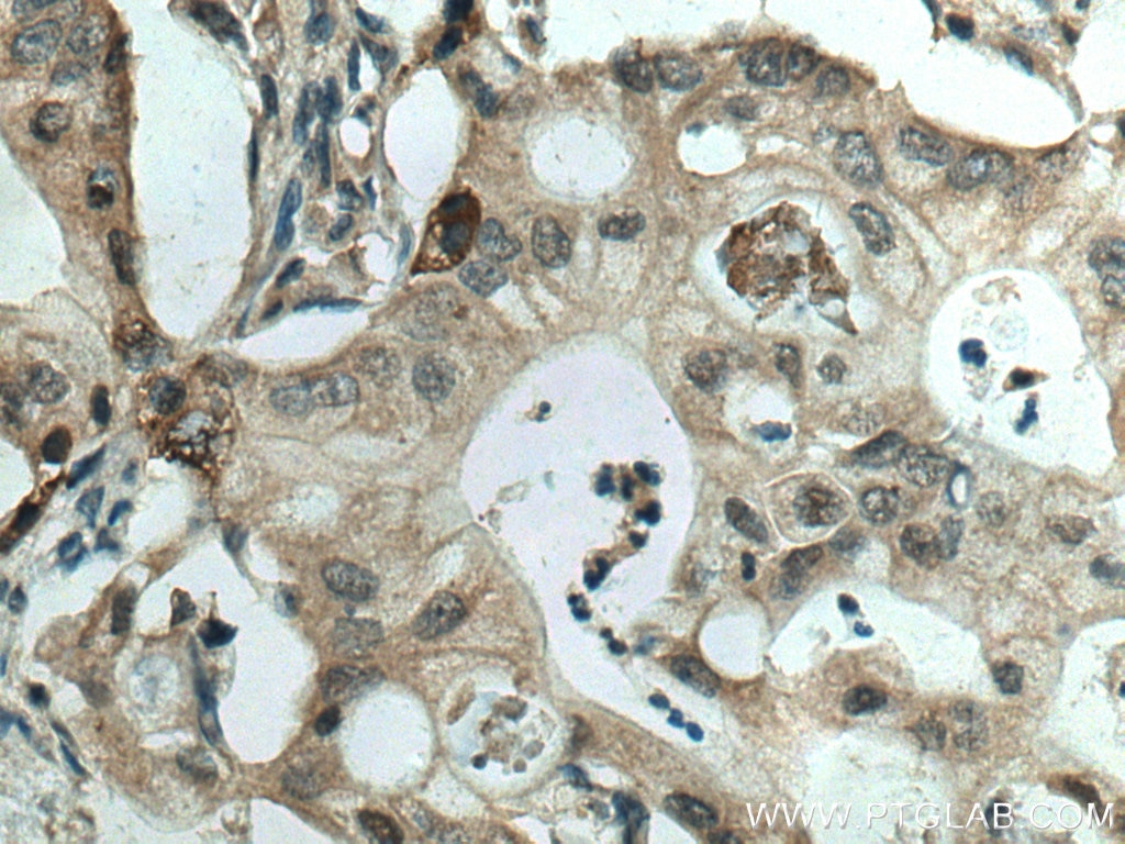 Immunohistochemistry (IHC) staining of human pancreas cancer tissue using MAPK13 Monoclonal antibody (60252-1-Ig)