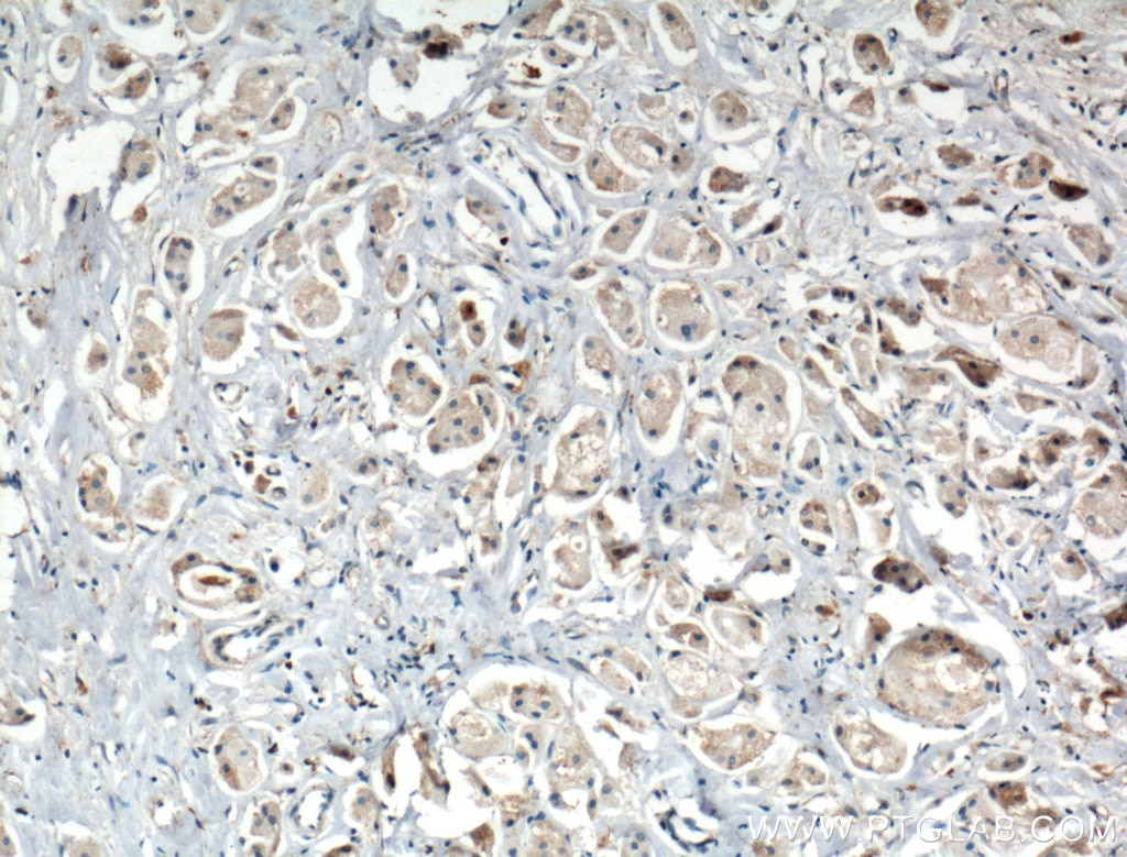 Immunohistochemistry (IHC) staining of human breast cancer tissue using MAPK4 Polyclonal antibody (26102-1-AP)