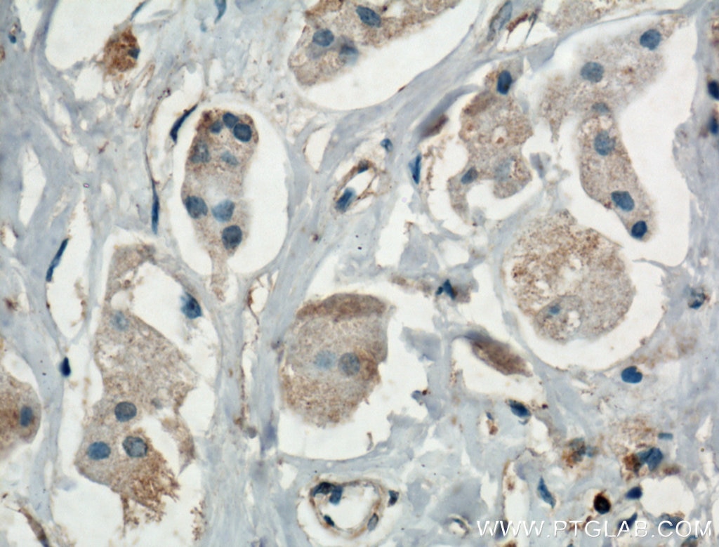 Immunohistochemistry (IHC) staining of human breast cancer tissue using MAPK4 Polyclonal antibody (26102-1-AP)