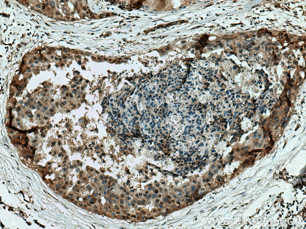 Immunohistochemistry (IHC) staining of human breast cancer tissue using MAPKAPK2 Polyclonal antibody (13949-1-AP)