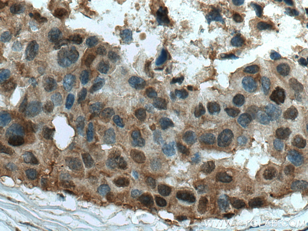 IHC staining of human breast cancer using 13949-1-AP