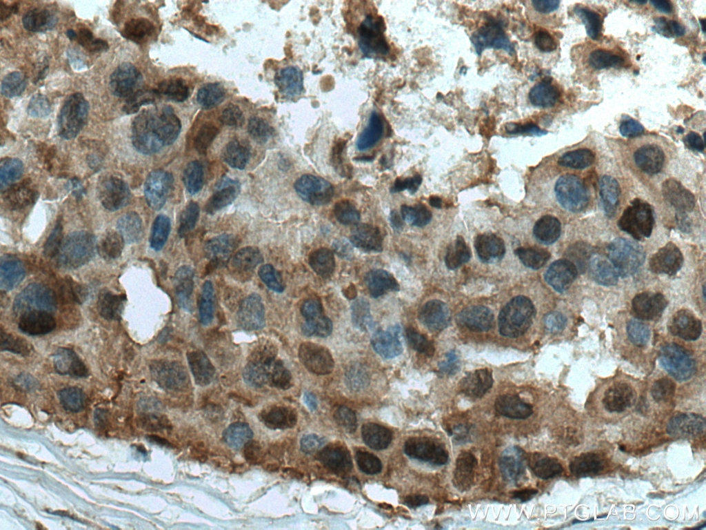 Immunohistochemistry (IHC) staining of human breast cancer tissue using MAPKAPK2 Polyclonal antibody (13949-1-AP)