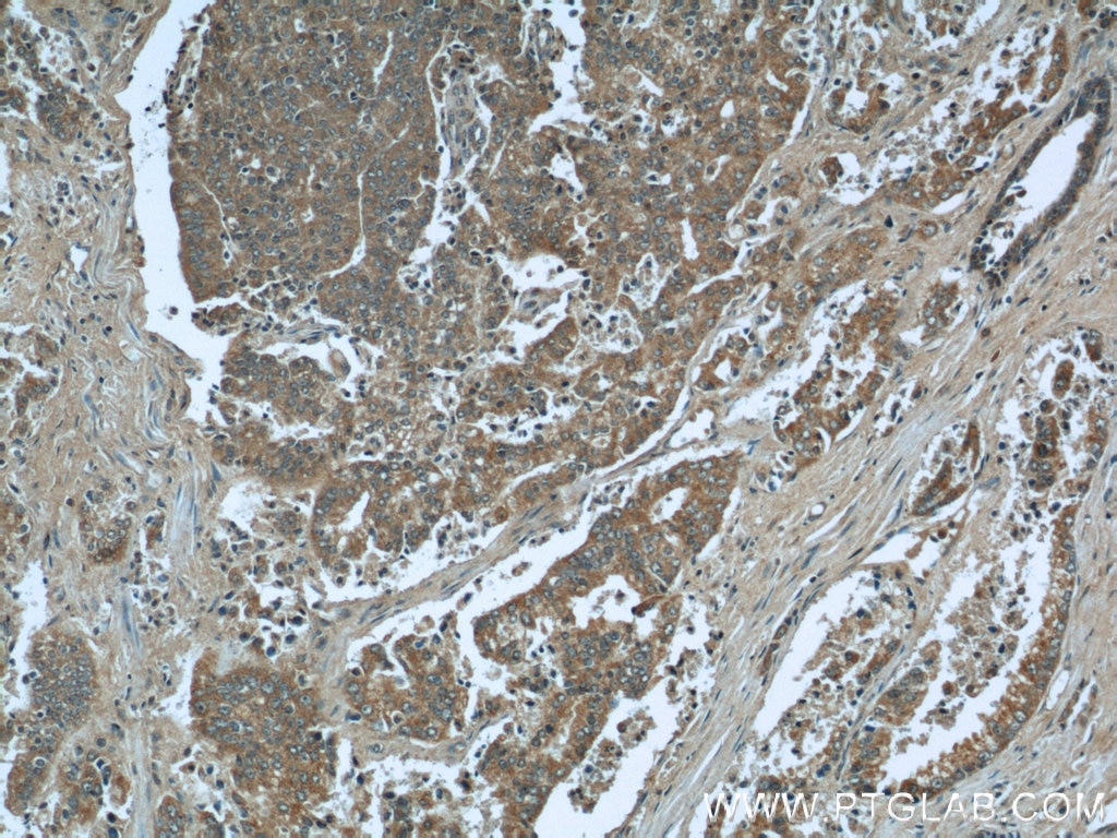 Immunohistochemistry (IHC) staining of human prostate cancer tissue using MAPKSP1 Polyclonal antibody (11937-1-AP)