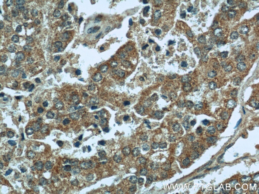 Immunohistochemistry (IHC) staining of human prostate cancer tissue using MAPKSP1 Polyclonal antibody (11937-1-AP)