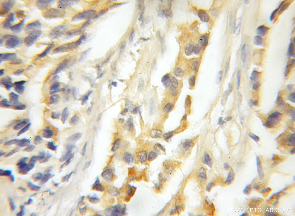 Immunohistochemistry (IHC) staining of human prostate cancer tissue using MAPKSP1 Polyclonal antibody (11937-1-AP)