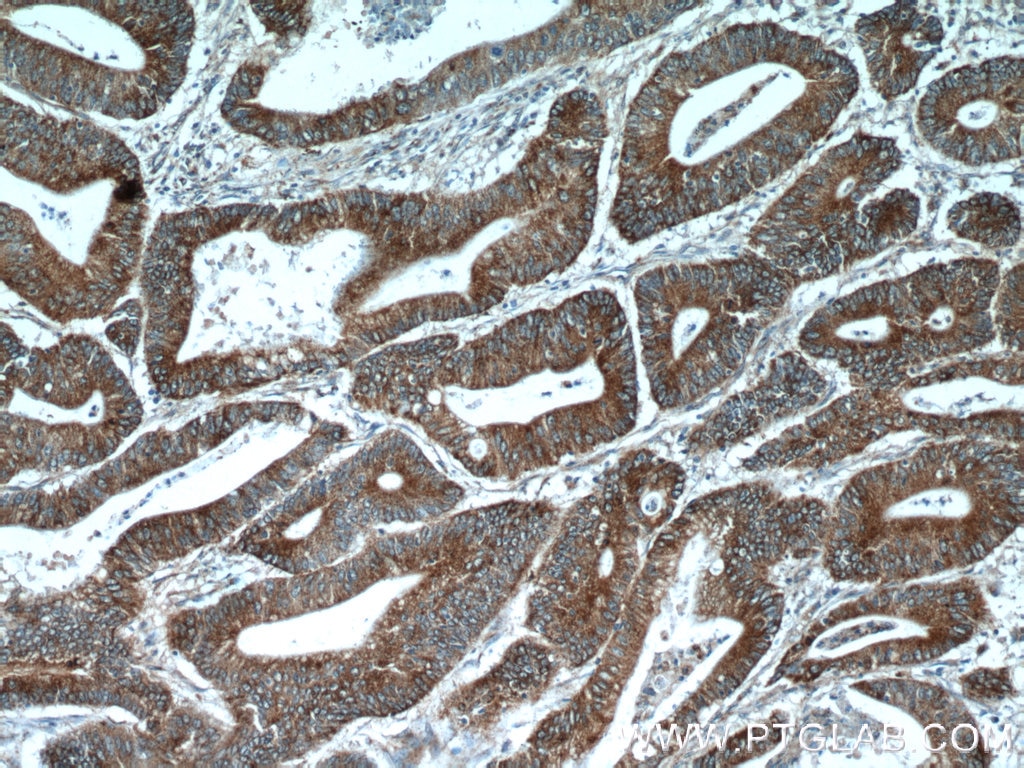 IHC staining of human colon cancer using 17717-1-AP