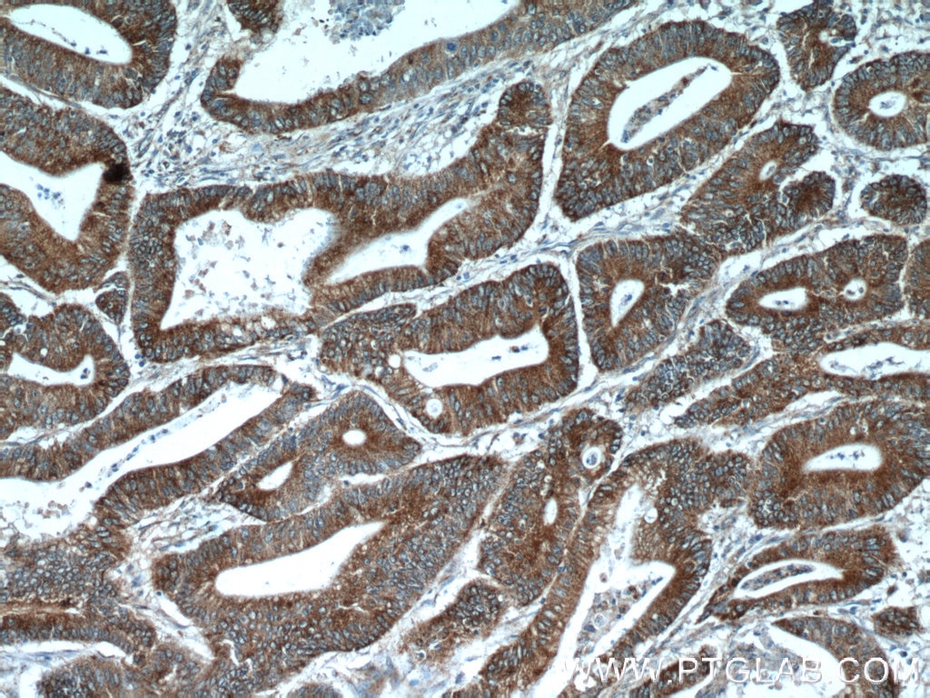 Immunohistochemistry (IHC) staining of human colon cancer tissue using EB1 Polyclonal antibody (17717-1-AP)