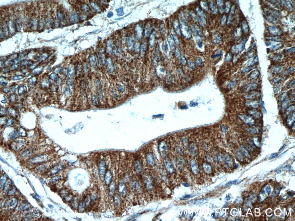 Immunohistochemistry (IHC) staining of human colon cancer tissue using EB1 Polyclonal antibody (17717-1-AP)