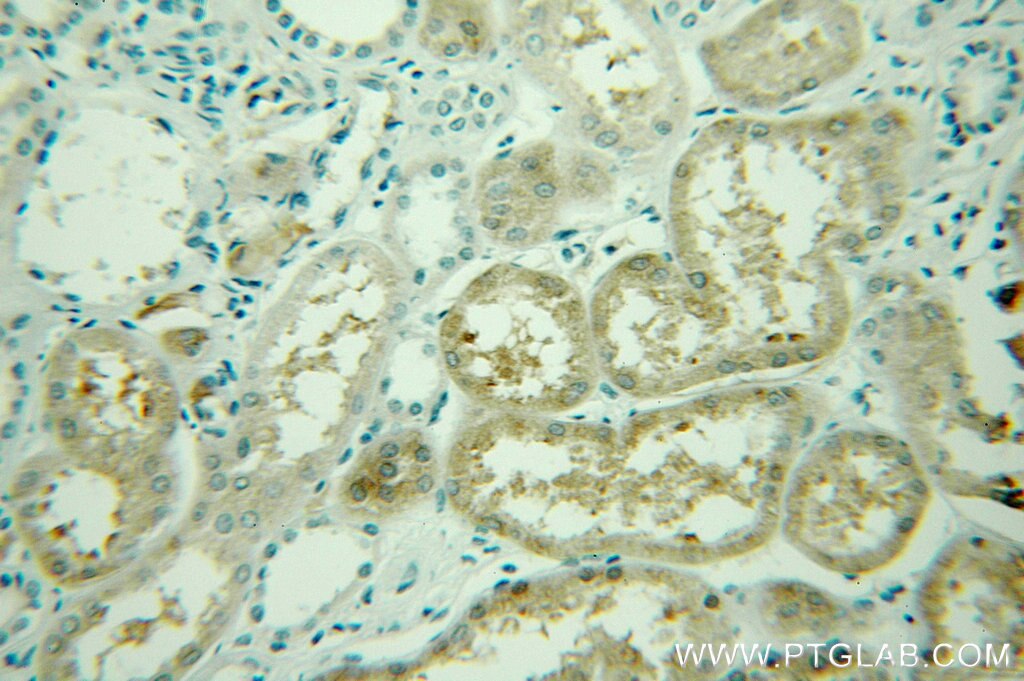 IHC staining of human lung cancer using 10274-1-AP