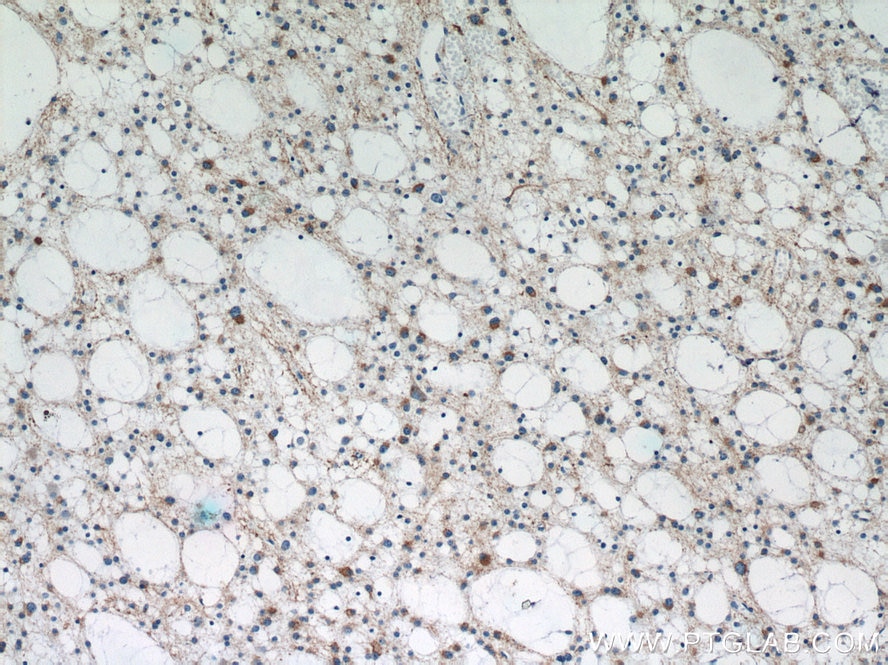 Immunohistochemistry (IHC) staining of human gliomas tissue using TAU Polyclonal antibody (10274-1-AP)