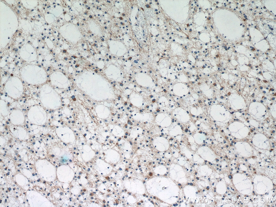 IHC staining of human gliomas using 10274-1-AP