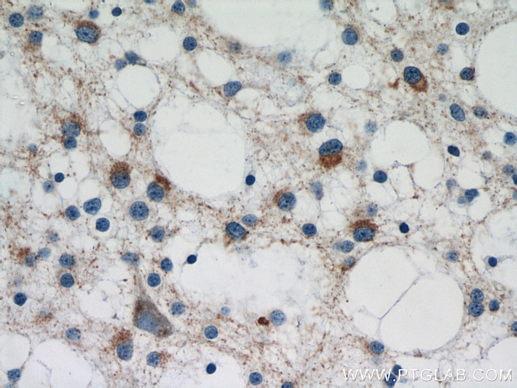 IHC staining of human gliomas using 10274-1-AP