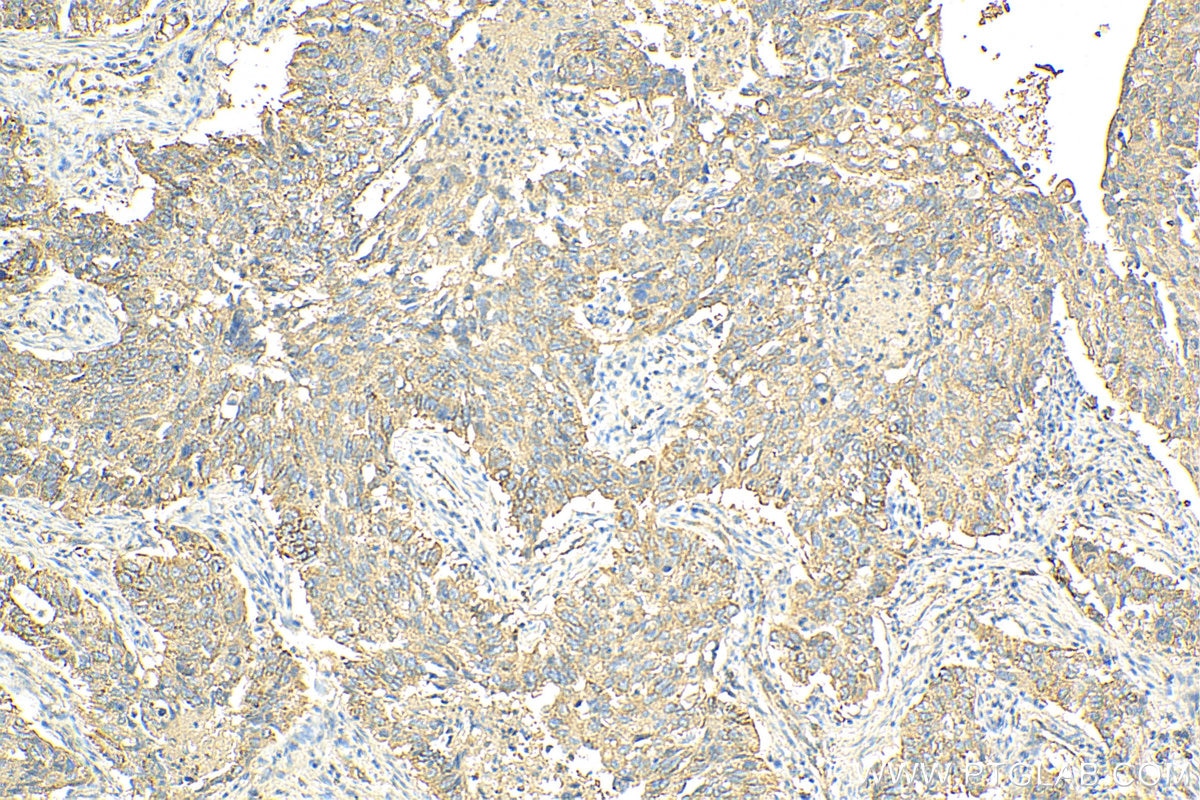 Immunohistochemistry (IHC) staining of human lung cancer tissue using MARCKSL1 Polyclonal antibody (11422-1-AP)