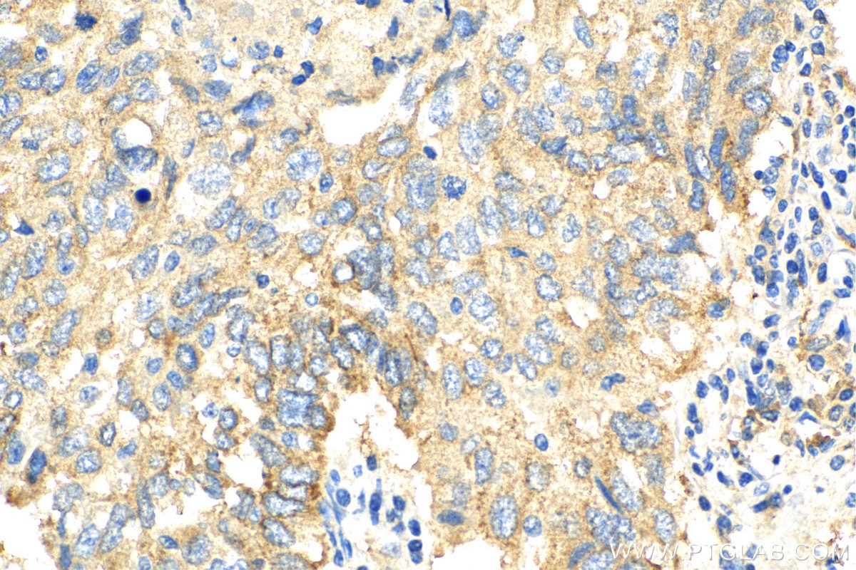 Immunohistochemistry (IHC) staining of human lung cancer tissue using MARCKSL1 Polyclonal antibody (11422-1-AP)