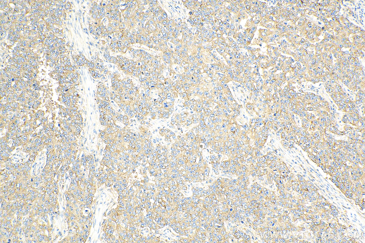 Immunohistochemistry (IHC) staining of human breast cancer tissue using MARCKSL1 Polyclonal antibody (11422-1-AP)