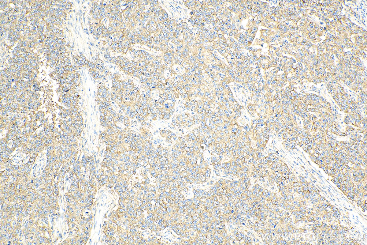 Immunohistochemistry (IHC) staining of human breast cancer tissue using MARCKSL1 Polyclonal antibody (11422-1-AP)