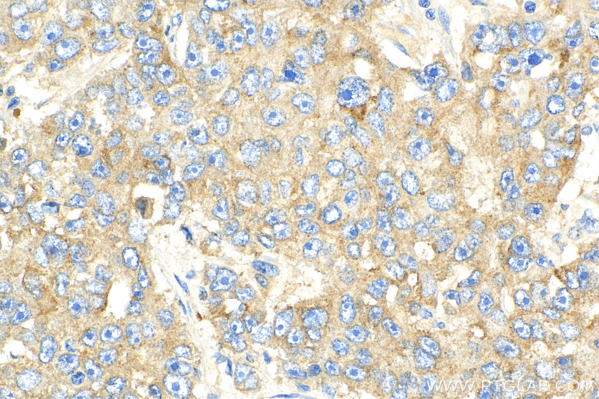 Immunohistochemistry (IHC) staining of human breast cancer tissue using MARCKSL1 Polyclonal antibody (11422-1-AP)