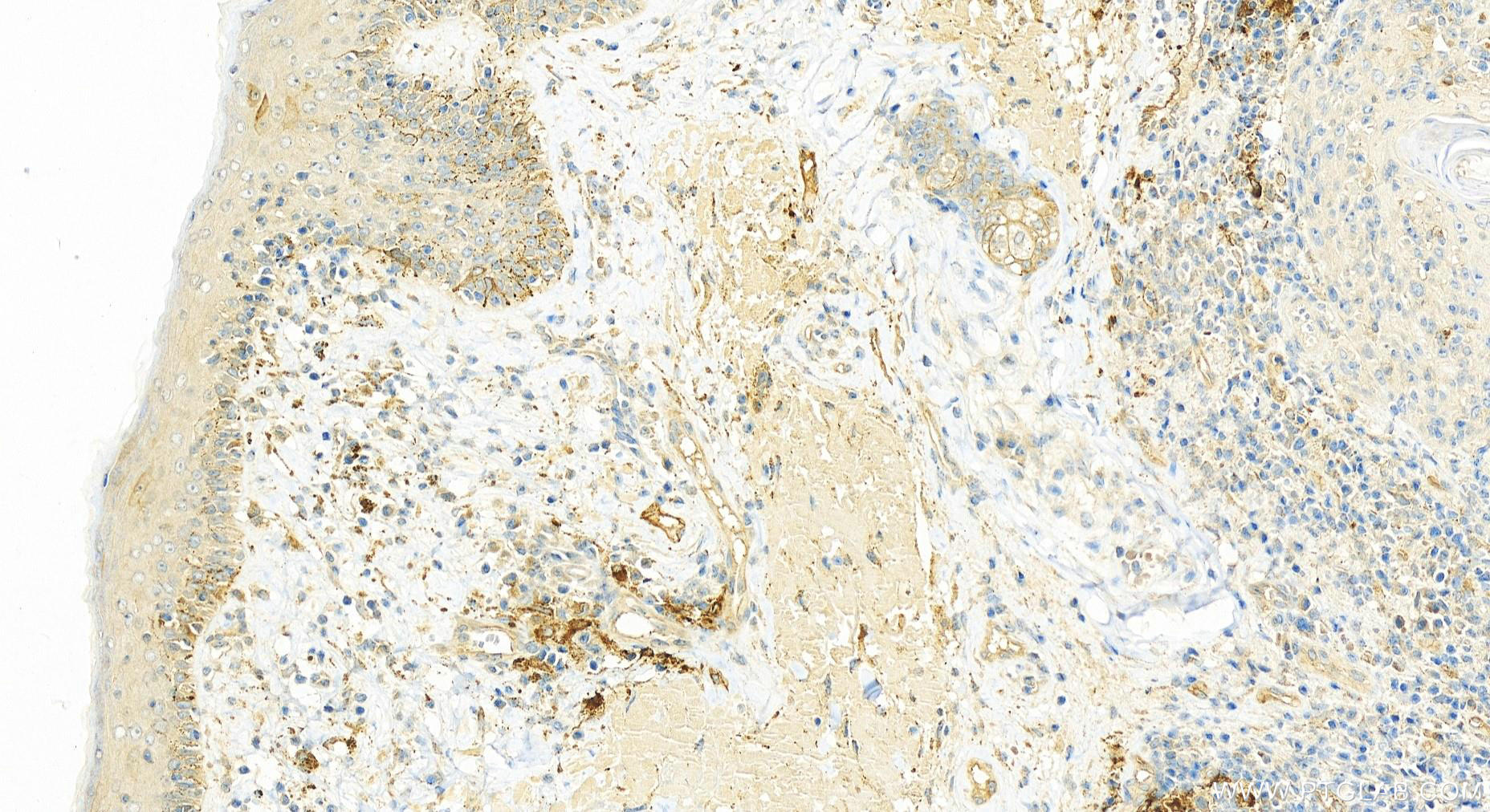 Immunohistochemistry (IHC) staining of skin cancer using MARCKSL1 Polyclonal antibody (14124-1-AP)