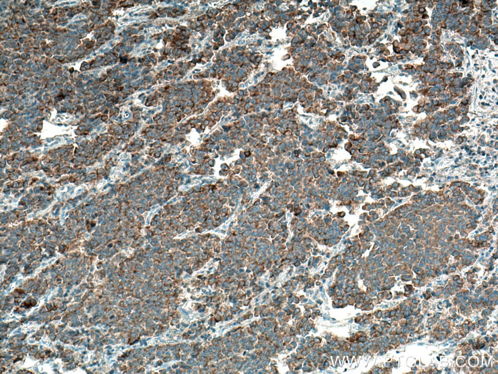 Immunohistochemistry (IHC) staining of human prostate cancer tissue using MARK2 Polyclonal antibody (15492-1-AP)