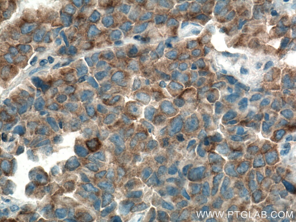 Immunohistochemistry (IHC) staining of human prostate cancer tissue using MARK2 Polyclonal antibody (15492-1-AP)